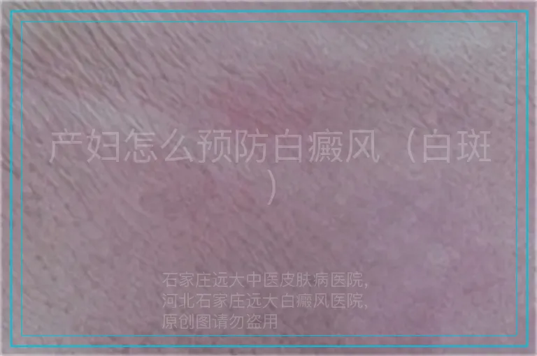 产妇怎么预防白癜风（白斑）