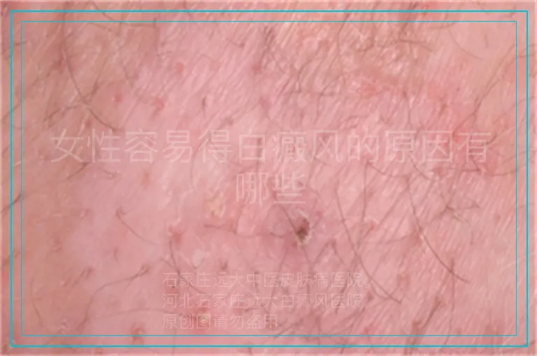 女性容易得白癜风的原因有哪些