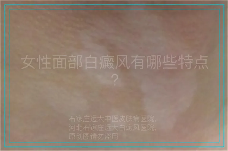 女性面部白癜风有哪些特点?