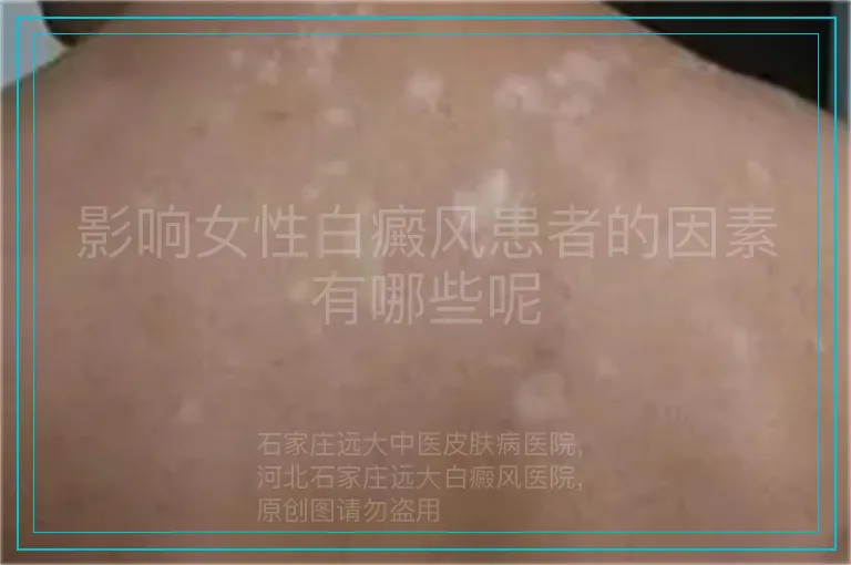 影响女性白癜风患者的因素有哪些呢
