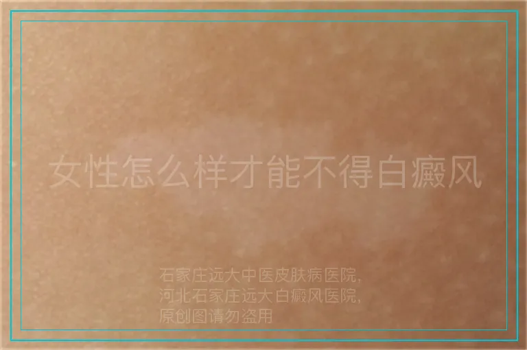 女性怎么样才能不得白癜风
