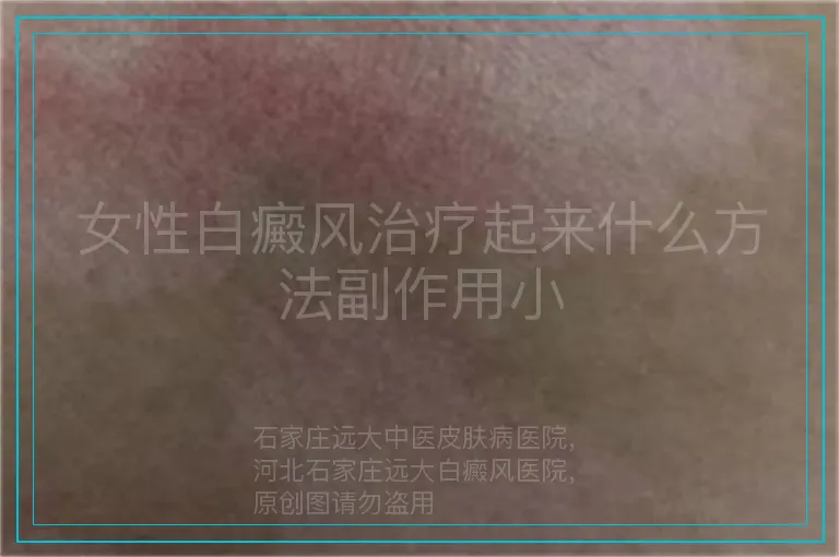 女性白癜风治疗起来什么方法副作用小