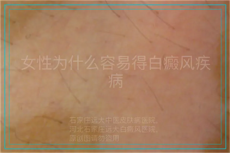 女性为什么容易得白癜风疾病