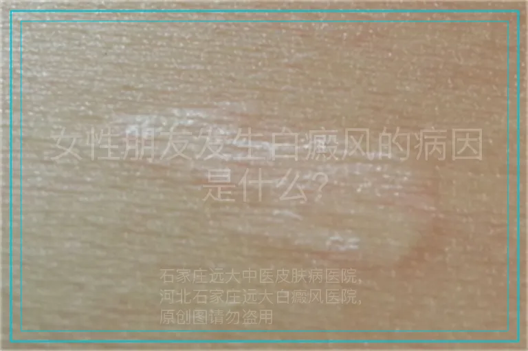 女性朋友发生白癜风的病因是什么?
