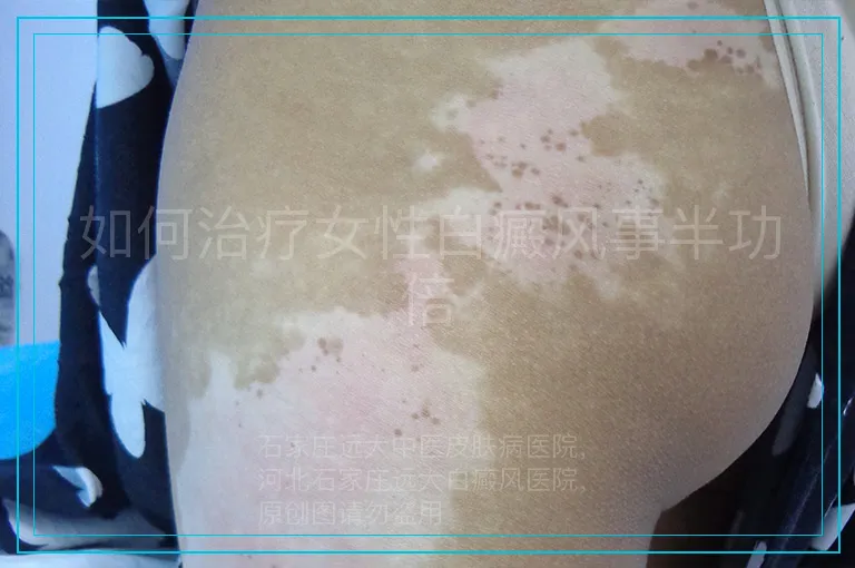 如何治疗女性白癜风事半功倍