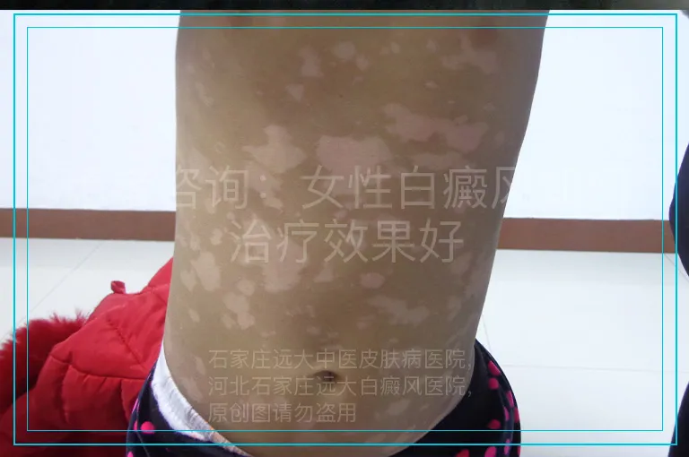 患者咨询：女性白癜风如何治疗效果好