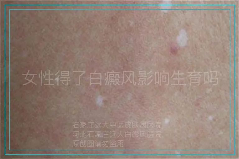 女性得了白癜风影响生育吗