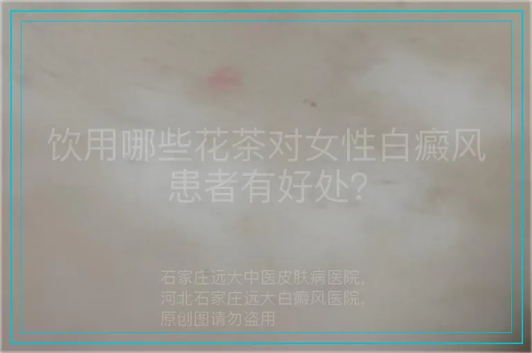 饮用哪些花茶对女性白癜风患者有好处？
