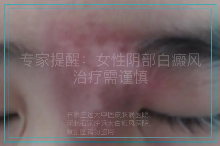 专家提醒：女性阴部白癜风治疗需谨慎