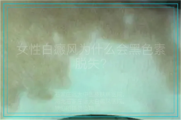 女性白癜风为什么会黑色素脱失?