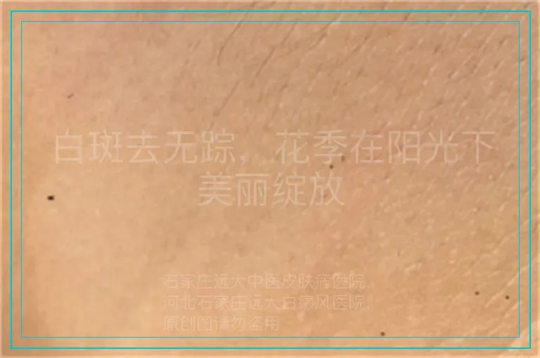 白斑去无踪，花季在阳光下美丽绽放