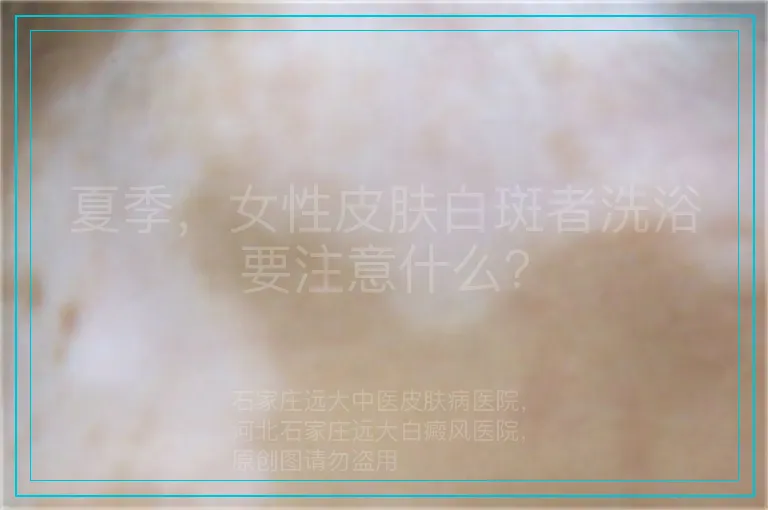 夏季，女性皮肤白斑者洗浴要注意什么？