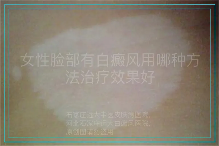 女性脸部有白癜风用哪种方法治疗效果好