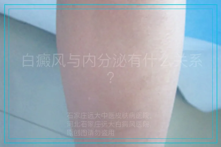 白癜风与内分泌有什么关系？