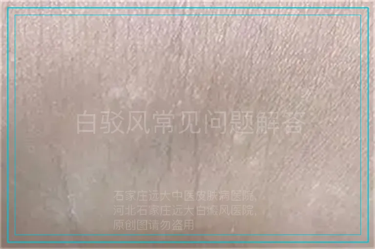 白驳风常见问题解答