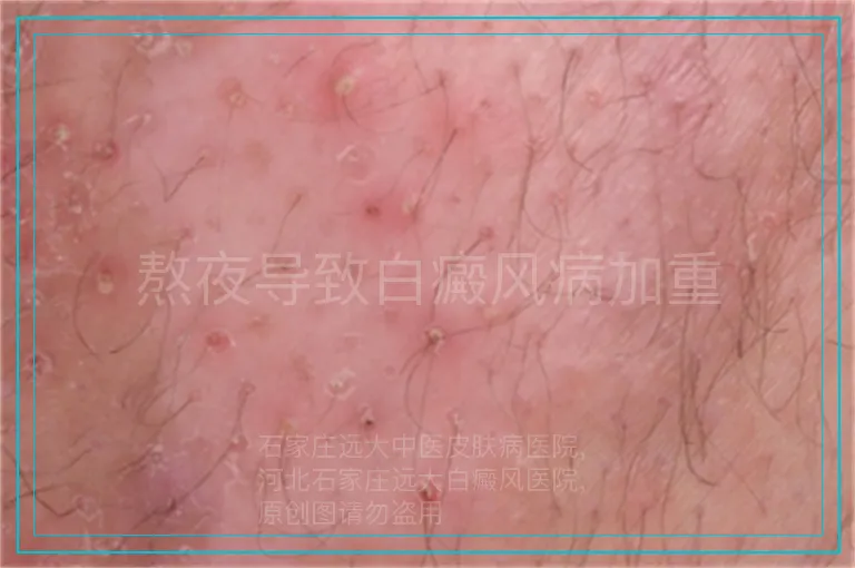 熬夜导致白癜风病加重