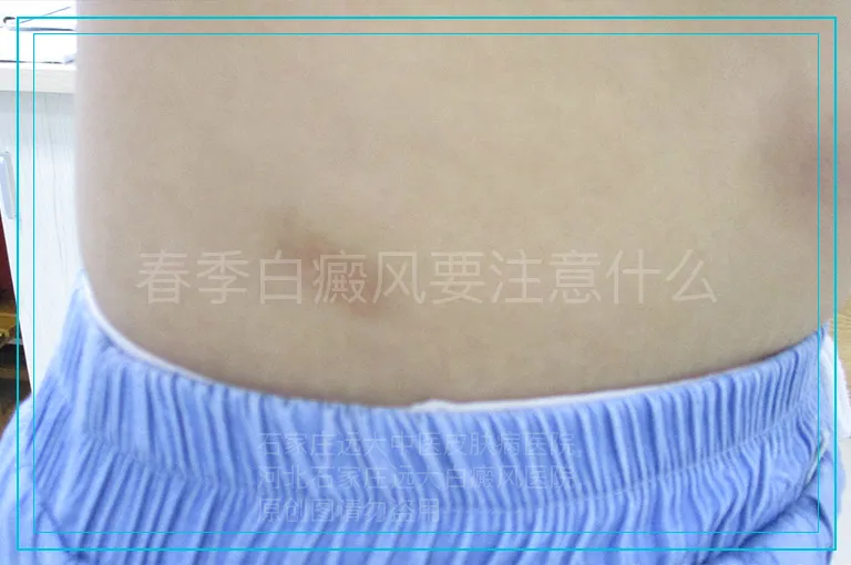 春季白癜风要注意什么
