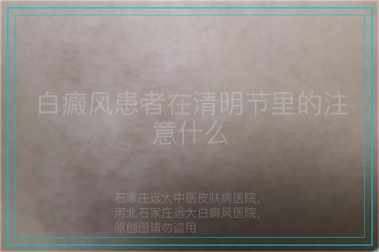 白癜风患者在清明节里的注意什么