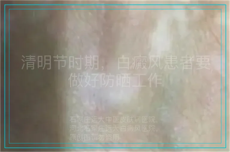 清明节时期，白癜风患者要做好防晒工作