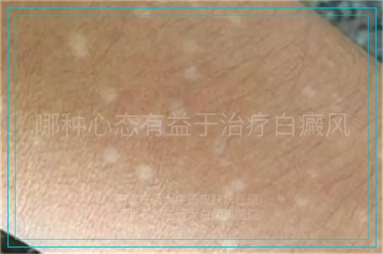 哪种心态有益于治疗白癜风