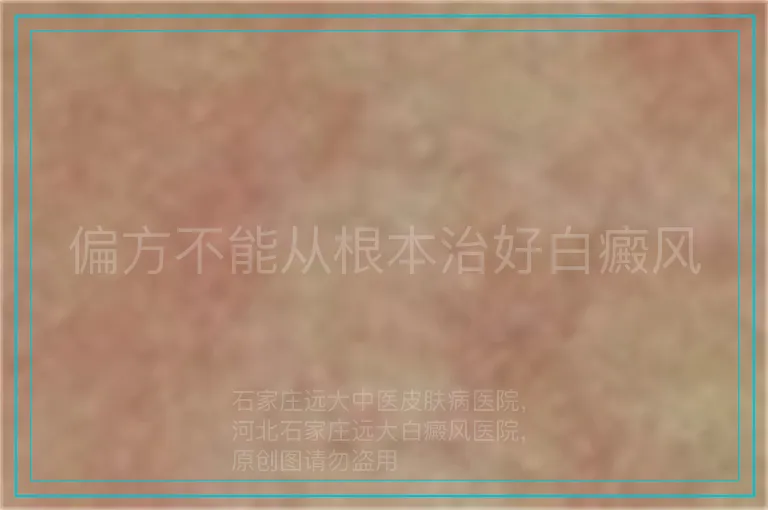偏方不能从根本治好白癜风