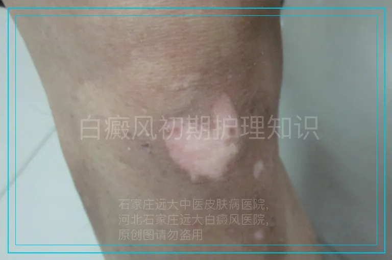 白癜风初期护理知识