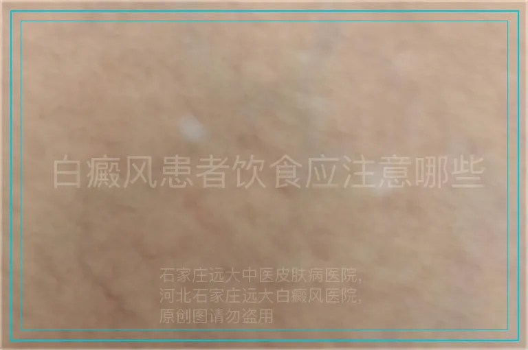 白癜风患者饮食应注意哪些