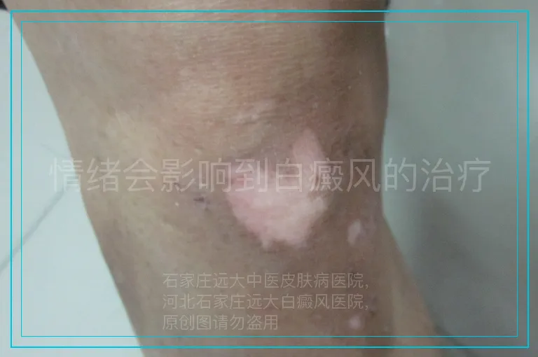 情绪会影响到白癜风的治疗