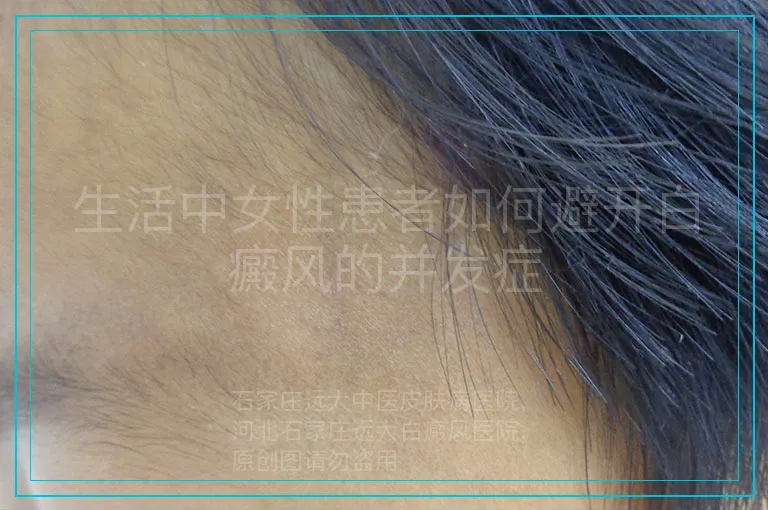生活中女性患者如何避开白癜风的并发症