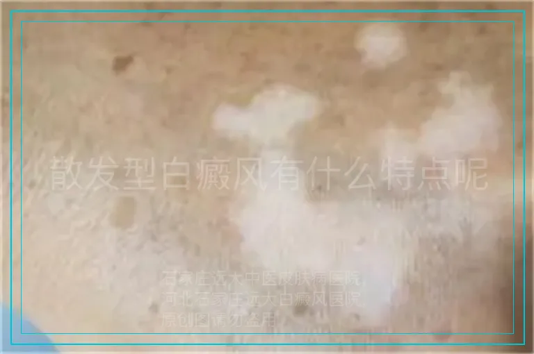 散发型白癜风有什么特点呢