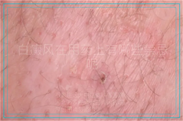 白癜风在用药上有哪些禁忌呢