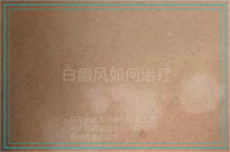 白癜风如何治疗