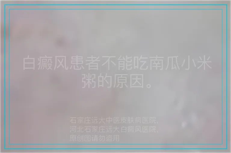 白癜风患者不能吃南瓜小米粥的原因。