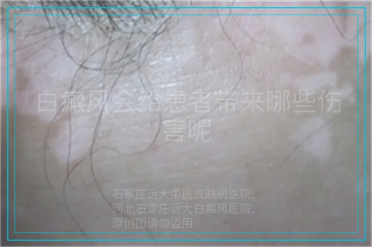 白癜风会给患者带来哪些伤害呢