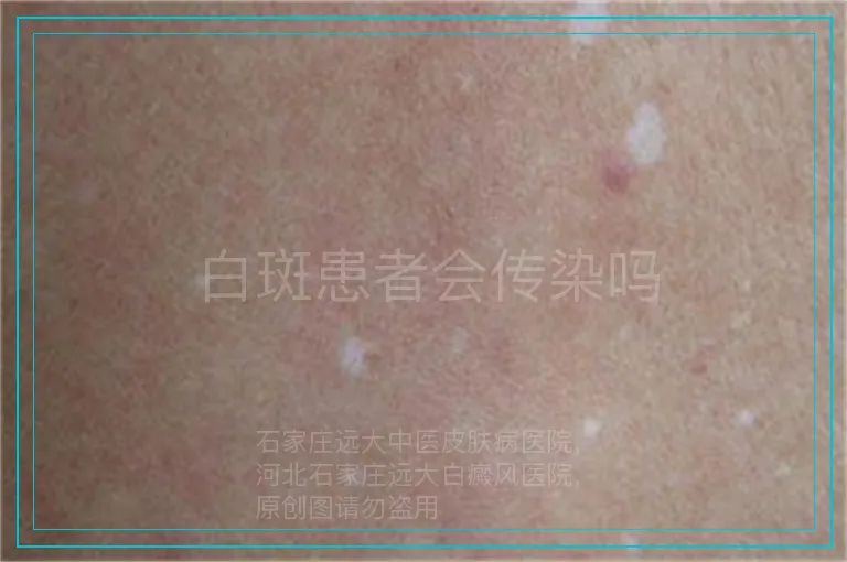 白斑患者会传染吗