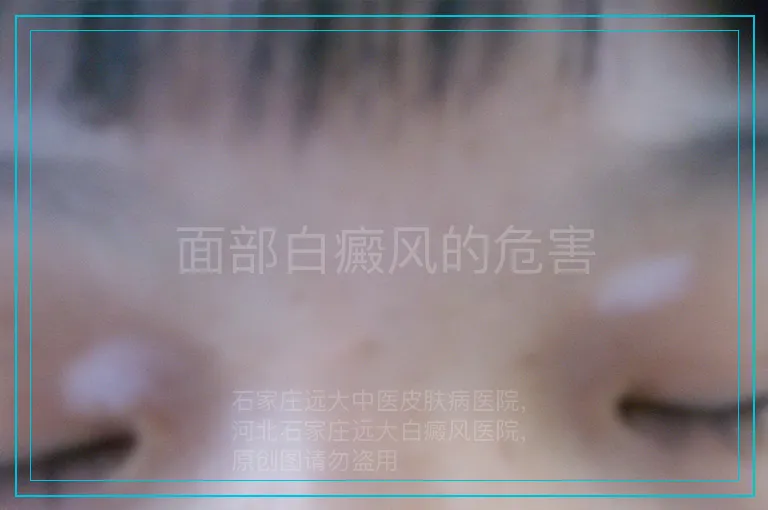 面部白癜风的危害