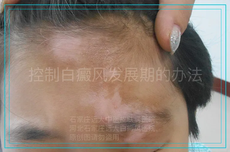 控制白癜风发展期的办法