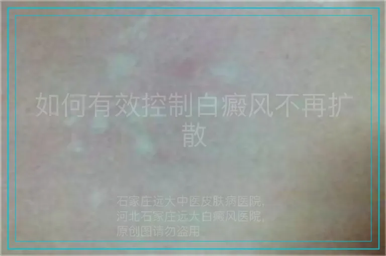 如何有效控制白癜风不再扩散