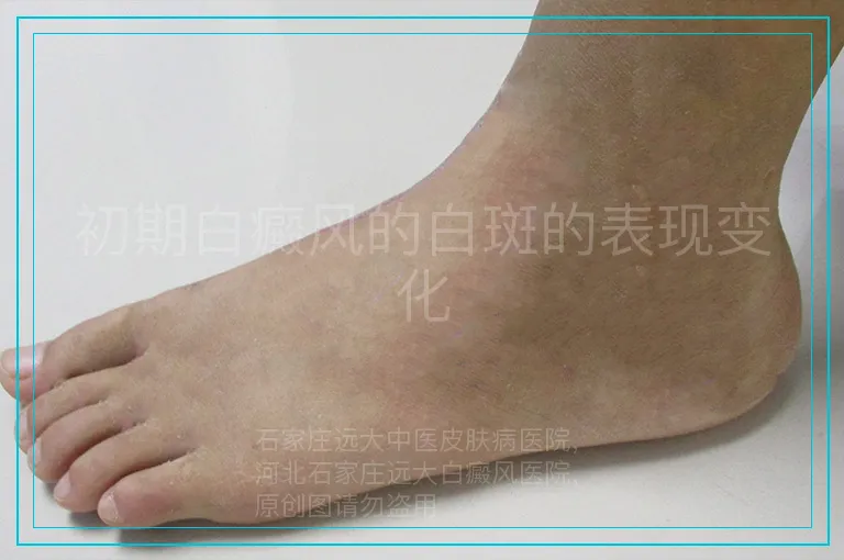 初期白癜风的白斑的表现变化