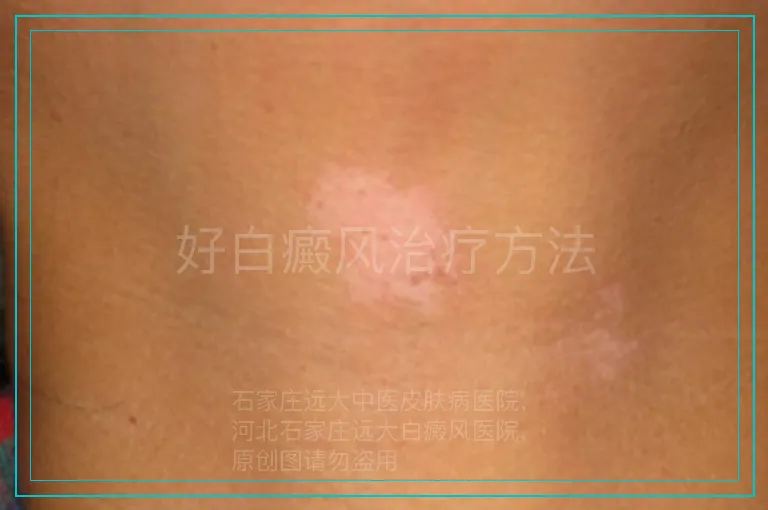 好白癜风治疗方法