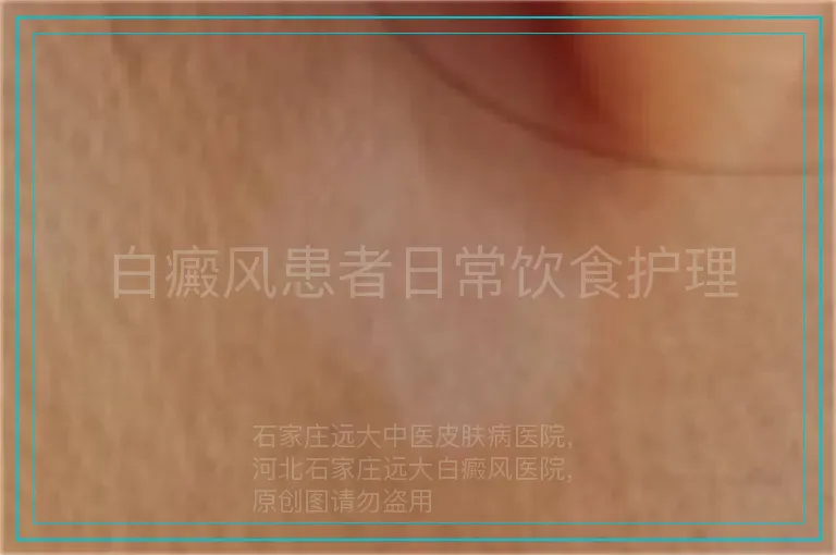 白癜风患者日常饮食护理