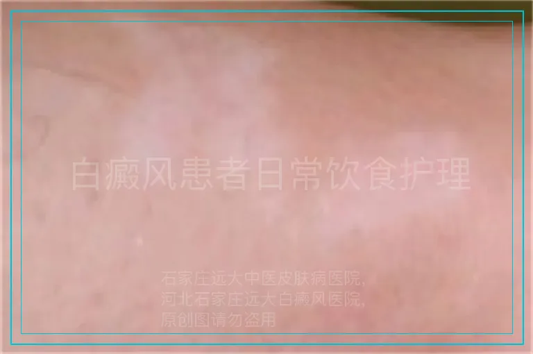 白癜风患者日常饮食护理