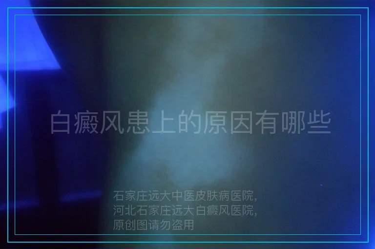 白癜风患上的原因有哪些