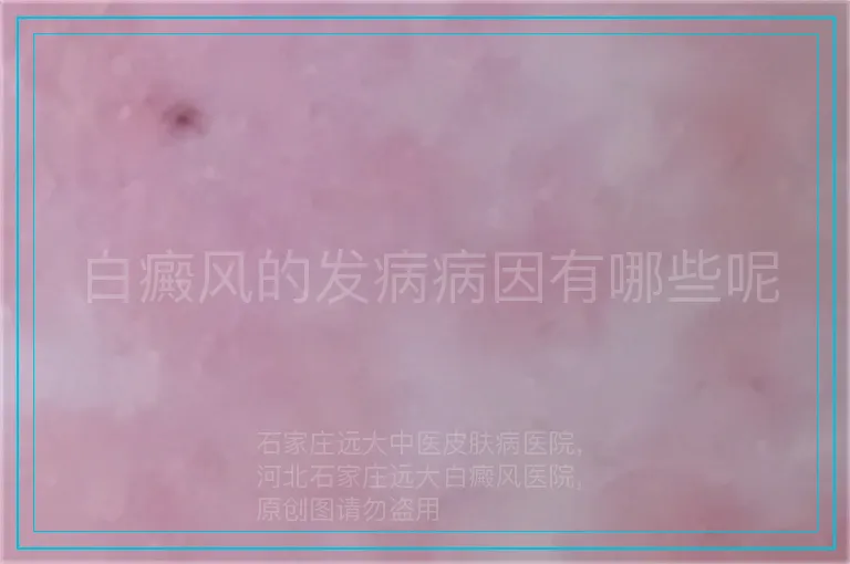 白癜风的发病病因有哪些呢