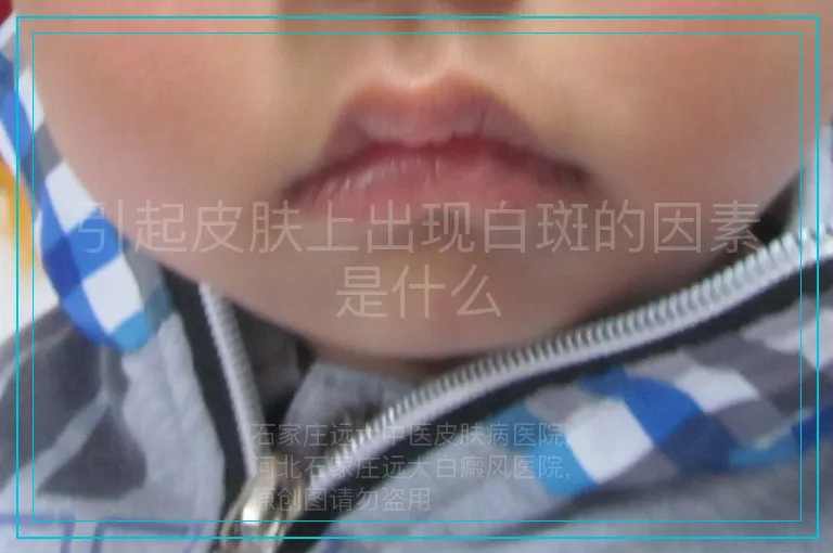 引起皮肤上出现白斑的因素是什么