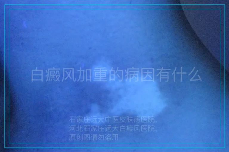 白癜风加重的病因有什么