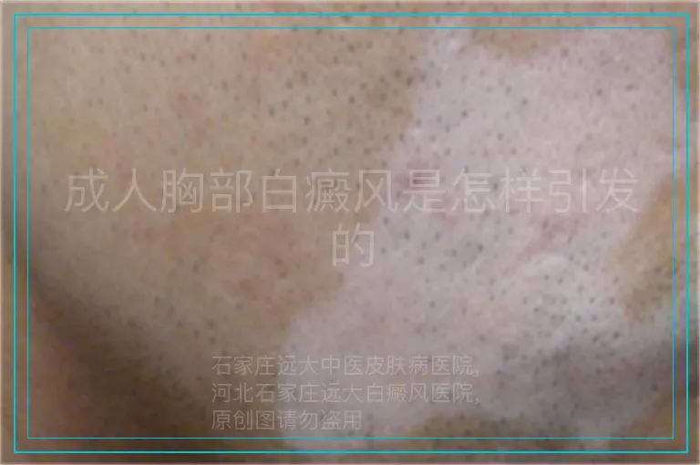 成人胸部白癜风是怎样引发的