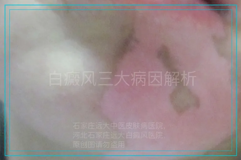 白癜风三大病因解析