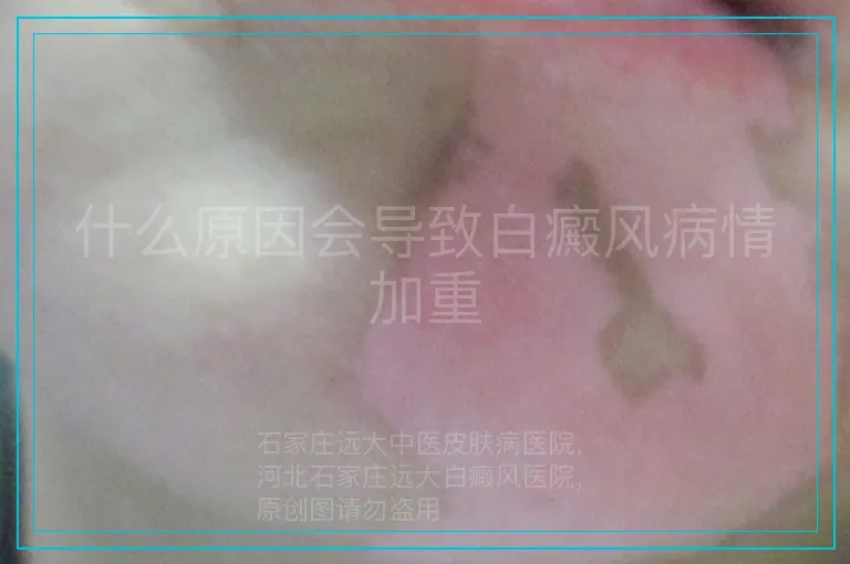 什么原因会导致白癜风病情加重