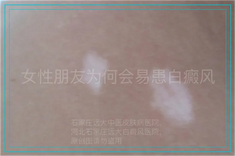 女性朋友为何会易患白癜风